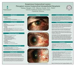 Suspicious Conjunctival Lesion-Pterygium versus Conjunctival Intraepithelial Neoplasia